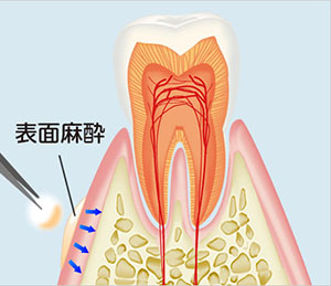 表面麻酔
