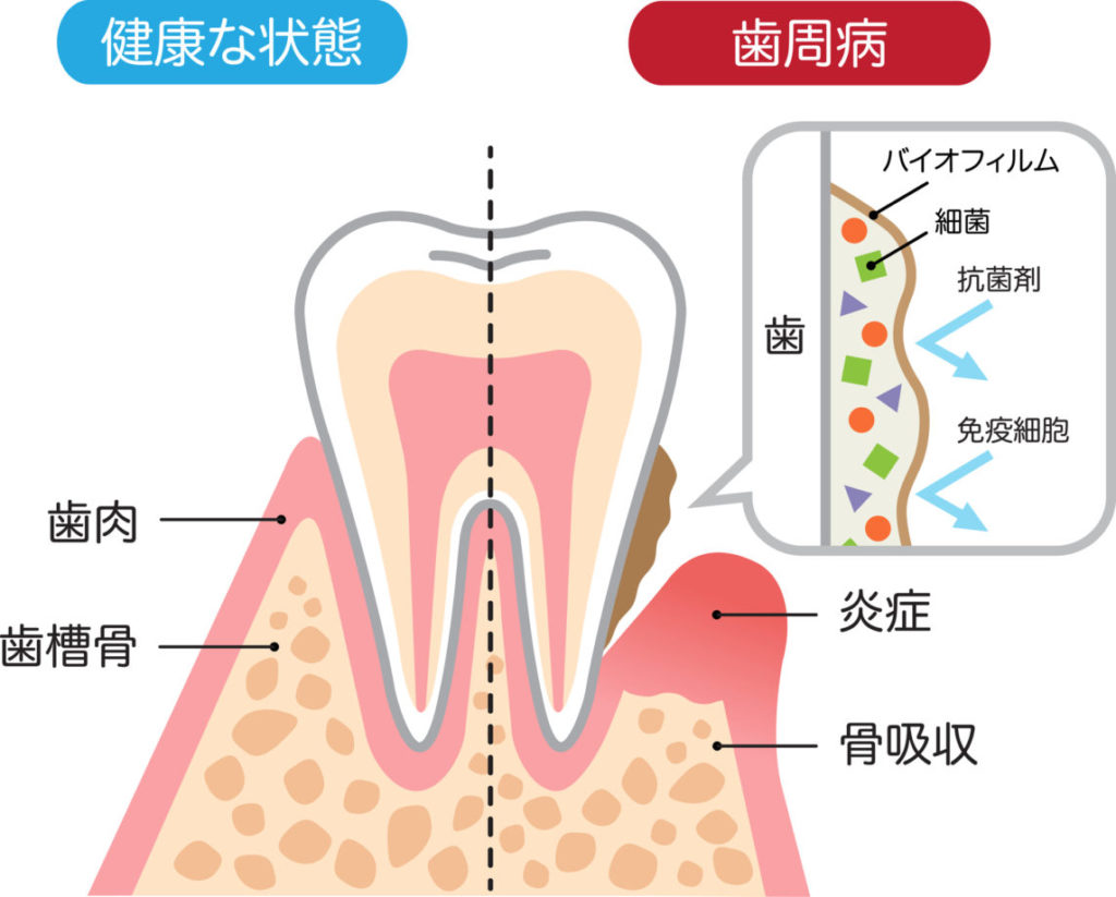 健康な歯ぐきと歯周病の歯ぐきの断面図