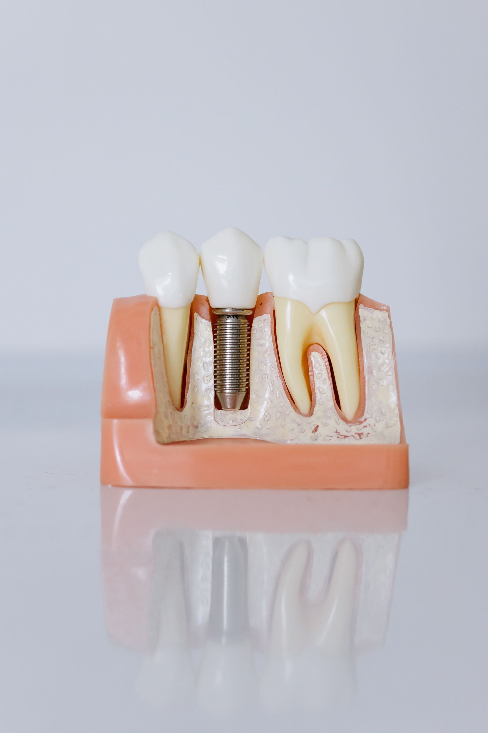 インプラント治療のご案内 | 安谷屋歯科医院-Adaniya Dental Clinic-
