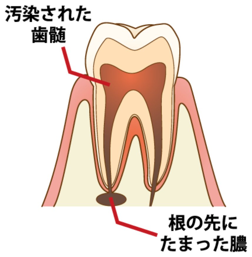 感染根管治療